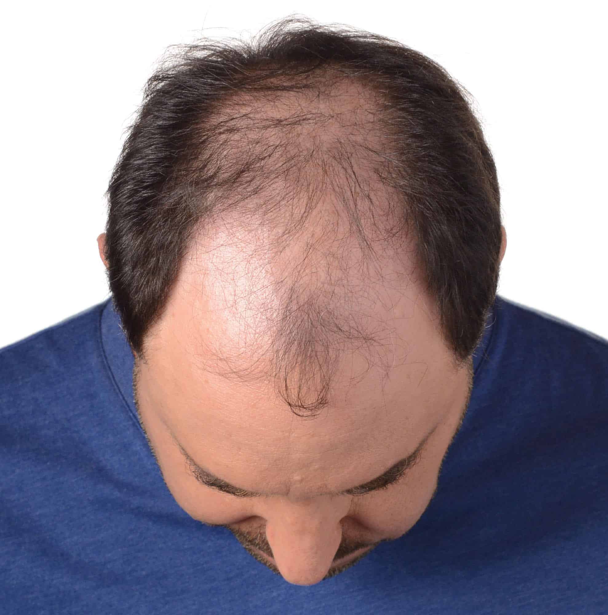 Thinning hair frustration